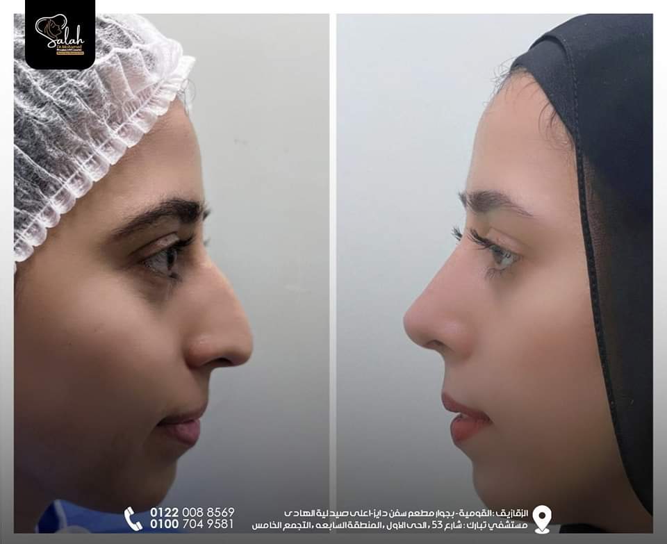 Crooked Nose Rhinoplasty